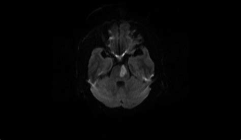 Acute Pontine Infarct MRI | Radiology Article on Acute Pontine stroke MRI