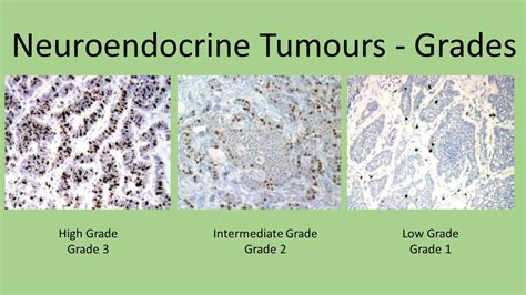 Pin on NETS - Neuroendocrine Cancer