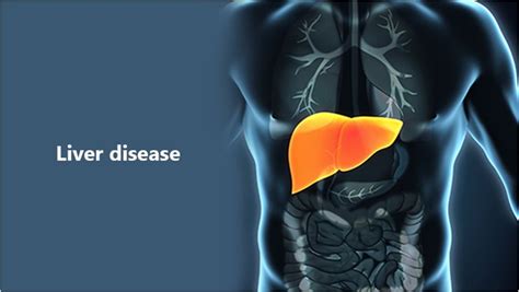 Liver Disease and Treatments That Actually Work – Centi Metro News ...