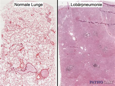 Lobar Pneumonia Histology