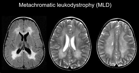 Znalezione obrazy dla zapytania leukodystrophies radiology approach