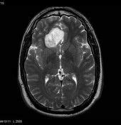 Intracranial epidermoid cyst | Radiology Reference Article ...