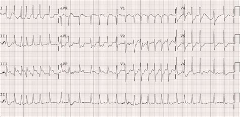 Dr. Smith's ECG Blog: Atrial Fibrillation with RVR and Inferoposterior ...