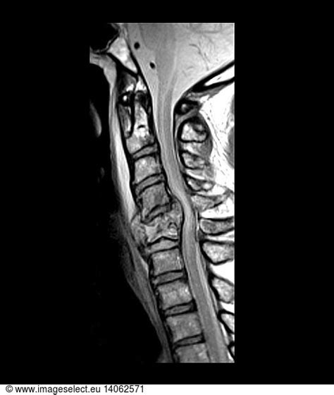 Cervical Spine Fracture Cervical Spine Fracture, MRI,abnormal,cervical ...