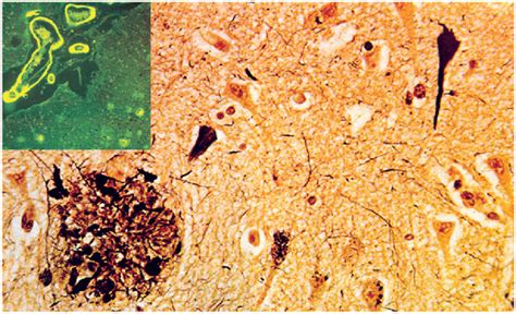 Histological lesions in Alzheimer's disease. Neurofibrillary tangles ...