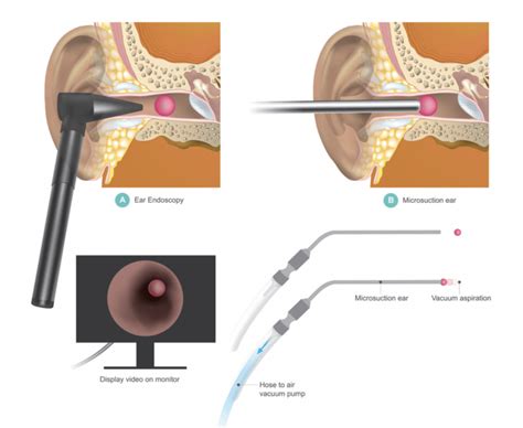 Ear Wax Removal at Thurles Family Practice – GP in Thurles