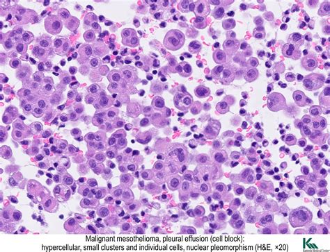 Pathology Outlines - Diffuse malignant mesothelioma