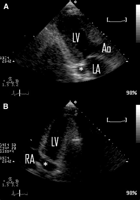 Persistent Left Superior Vena Cava Diagnosed by Bedside ...