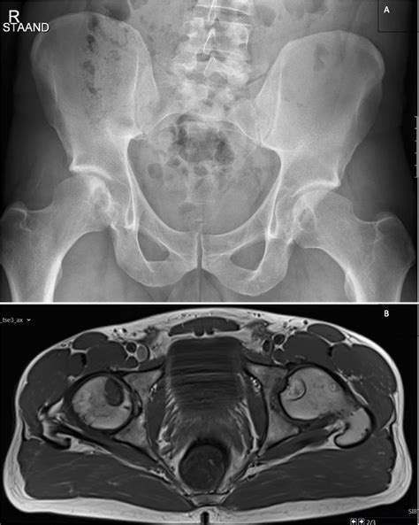 Subchondral Cyst