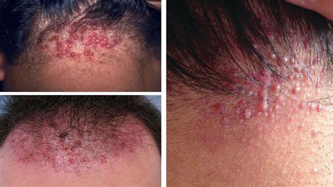 Folliculitis Scalp