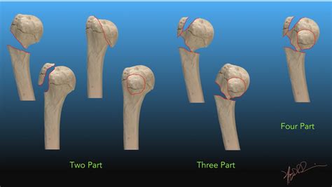 Neer Classification of Humeral Head Fractures | UW Emergency Radiology