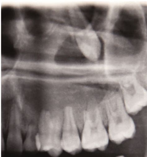 Adenomatoid Odontogenic Tumor (AOT) of Maxillary Sinus: Case Report ...