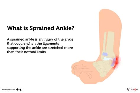 Sprained Ankle: Causes, Symptoms, Treatment and Cost