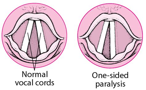 Vocal Cord Palsy | Vocal Cord Paresis | Dr Leslie Koh