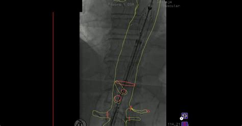 Treatment of an 83mm juxtarenal aortic aneurysm – Vascupedia