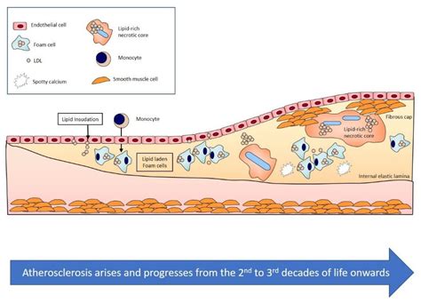 Atherosclerosis Diagram