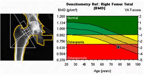 Osteoporosis & Bone Density - Boca Radiology Group