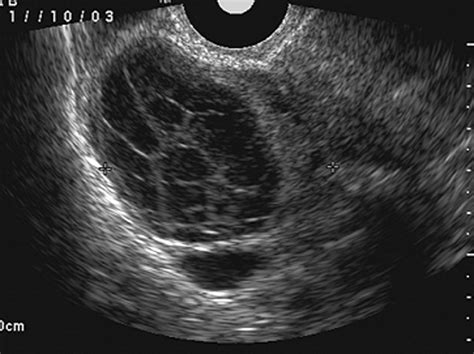 Imaging of Adnexal Masses in Pregnancy | Ultrasound, Diagnostic medical ...