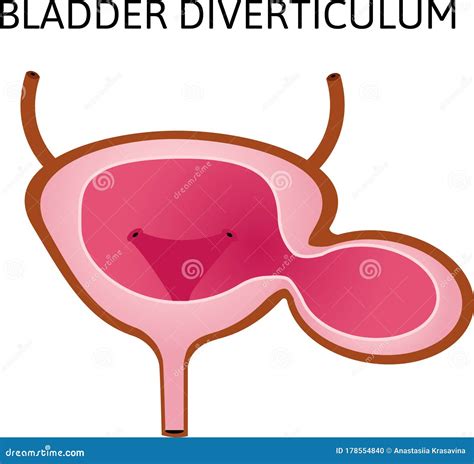 Diverticulum Cartoons, Illustrations & Vector Stock Images - 60 ...