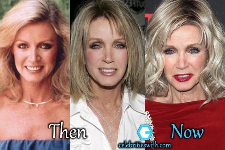 Donna Mills Plastic Surgery, Facelift, Necklift, Before and After ...