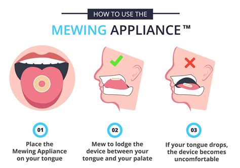 Mewing Appliance - A Device to Improve Your Facial Appearance