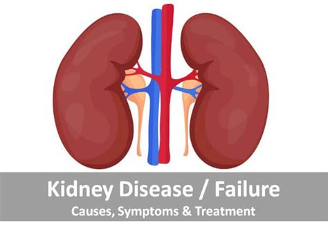 Kidney Failure Causes, Symptoms & Treatment | Kidney Disease