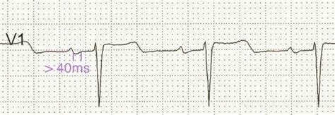 Left Atrial Enlargement • LITFL Medical Blog • ECG Library Basics