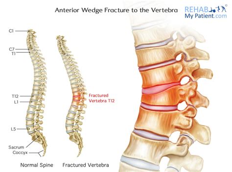 Anterior Wedge Fracture to the Vertebra | Rehab My Patient Vertebrae ...