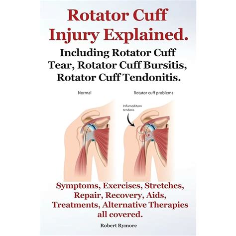 Rotator Cuff Injury Including Rotator Cuff Tear, Rotator Cuff Bursitis ...