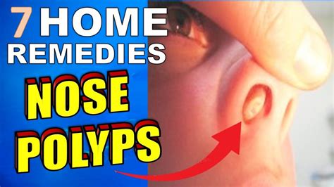 7 Natural Treatments & Home Remedies For Nasal Polyps - YouTube