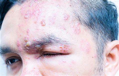 Shingles Treatment in NYC, Herpes Zoster, Shingles Rash