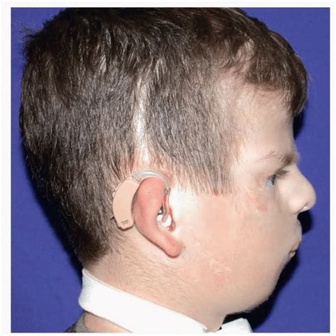 External Mandibular Distraction for Micrognathia | Plastic Surgery Key