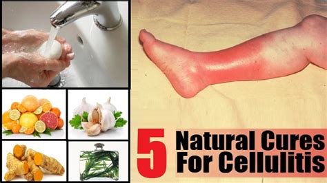 5 Home Remedies to Get Rid of Cellulitis Infection | By Top 5. - YouTube