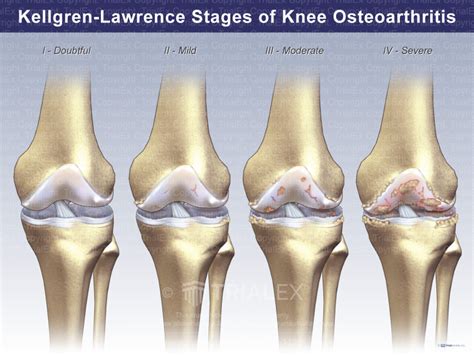 Kellgren-Lawrence Stages of Knee Osteoarthritis - TrialQuest Inc.