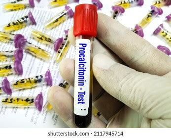 Blood Sample Tube Procalcitonin Test Diagnosis Stock Photo (Edit Now ...