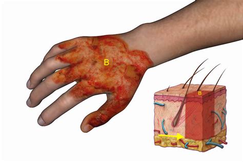 BURNS | Hand Surgery Resource