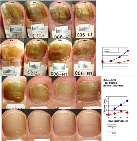 Nail Fungus - LZR7 LASER THERAPY