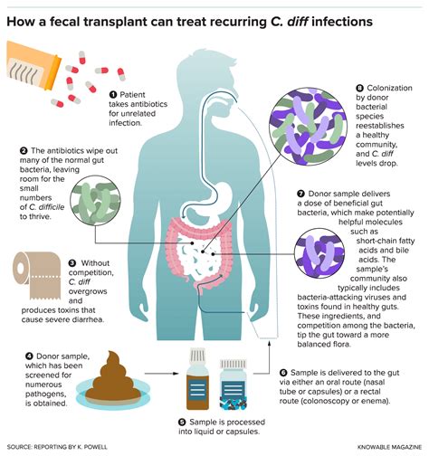 Infographic: How fecal transplants work against recurrent C. diff ...