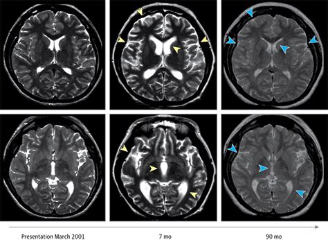 Cerebellar Atrophy and Long-term Outcome in Anti-NMDA Receptor ...