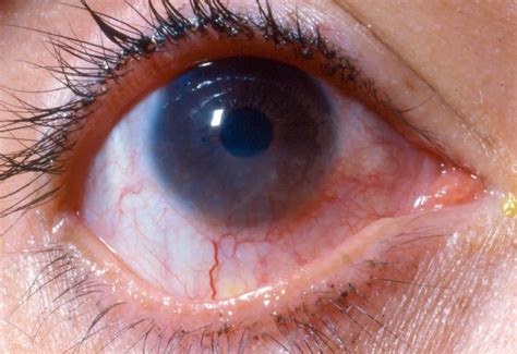 Staph phlyctenular keratoconjunctivitis - American Academy of Ophthalmology