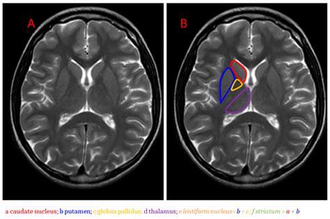 Basal Ganglia Lesions Basal Ganglia Mri Brain Brain Anatomy | Images ...