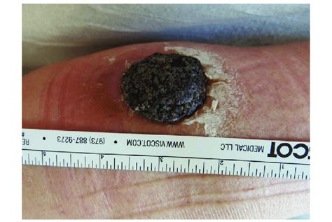 Irritated seborrheic keratosis resembling verrucous squamous cell ...