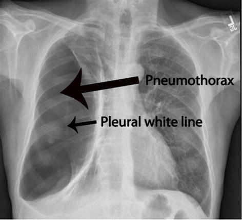 pneumotorax | Radiology student, Radiology imaging, Radiology schools