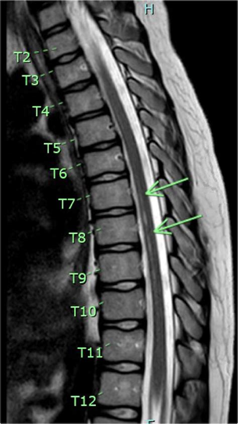 T2 sagittal MRI image of the thoracic spine with abnormal signal ...