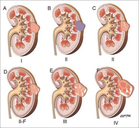 What Are Kidney Cysts? Kidney Cysts Symptoms, Causes, and Treatments ...