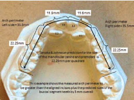 In this example of a Mixed Dentition Space Analysis, the Tanaka and ...