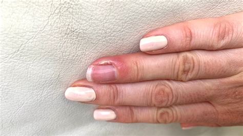 Infected cuticles: causes and the best treatment for cuticle damage