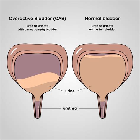 Study Links Overactive Bladder to Increased Falling Risk in Older Adults