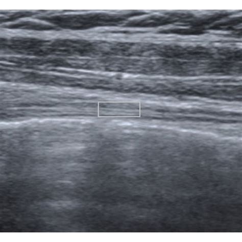 Biceps ultrasound. (a) Transverse view of the biceps tendon showing ...