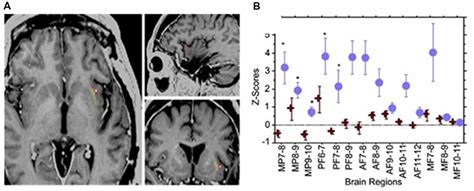 Frontiers | The Claustrum in Relation to Seizures and Electrical ...